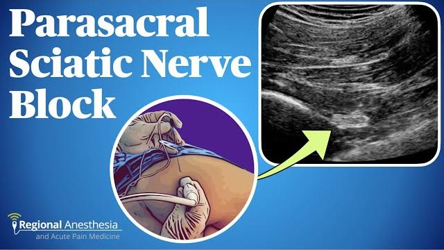 Ultrasound guided parasacral sciatic nerve block Ultrasound guided parasacral sciatic nerve block