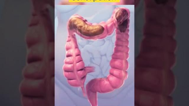 This is how constipation looks inside #viral #shortsvideo This is how constipation looks inside #viral #shortsvideo