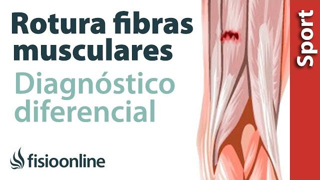 ¿cómo diferenciar si tienes una rotura de fibras o una contractura o espasmo muscular? ¿cómo diferenciar si tienes una rotura de fibras o una contractura o espasmo muscular?