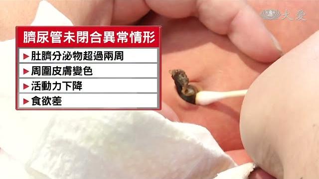 臍尿管閉合不全 囊腫破裂 尿液從肚臍噴出 臍尿管閉合不全 囊腫破裂 尿液從肚臍噴出