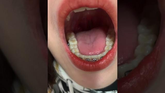 带牙套的美女口腔视频,舌头喉咙扁桃体,看全套加q2201573577或者资料联系方式 带牙套的美女口腔视频,舌头喉咙扁桃体,看全套加q2201573577或者资料联系方式