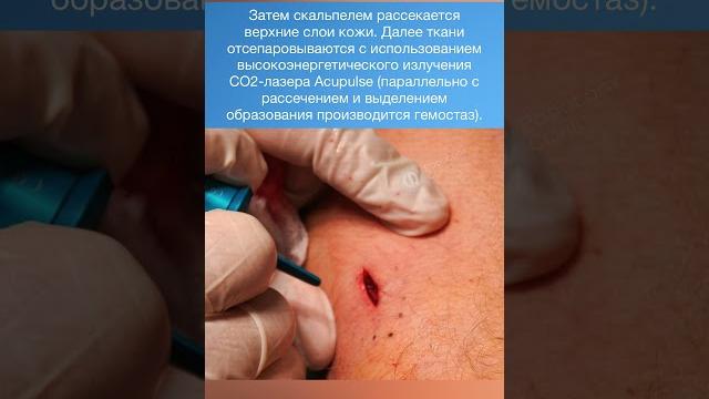 Удаление липомы #дерматологмосква #хирургия #хирург #липома #липоматоз #клиникаподологии Удаление липомы #дерматологмосква #хирургия #хирург #липома #липоматоз #клиникаподологии