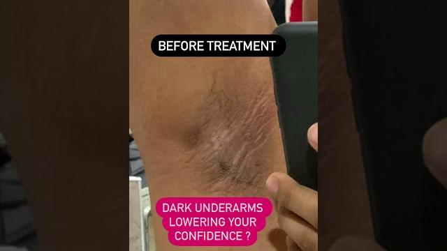 Dark underarms killing your confidence | dr ashima goel| dermatologist |chandigarh|mohali #shorts Dark underarms killing your confidence | dr ashima goel| dermatologist |chandigarh|mohali #shorts