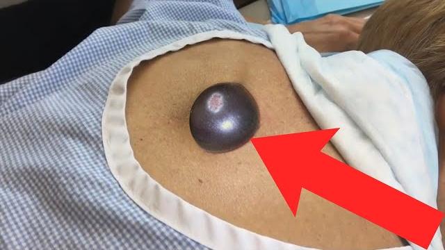 Удаление огромного прыща!!! Удаление огромного прыща!!!