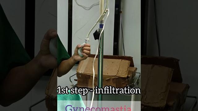 1 मिनट में देखिए gynecomastia surgery 1 मिनट में देखिए gynecomastia surgery