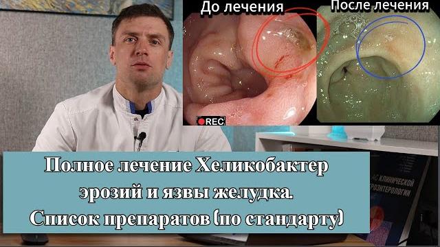 Лечим хр. язву желудка, эрозии и хеликобактер! за один раз и на долго. видео до и после лечения. Лечим хр. язву желудка, эрозии и хеликобактер! за один раз и на долго. видео до и после лечения.