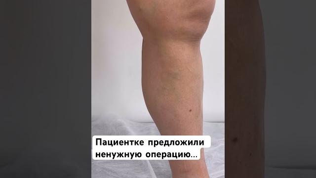 Добавочная варикозная вена. операция не нужна. провели узи вен ️ флеболог москва. флеболог Добавочная варикозная вена. операция не нужна. провели узи вен ️ флеболог москва. флеболог