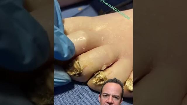 Doctor reacts: are these toenails dead? #shorts Doctor reacts: are these toenails dead? #shorts