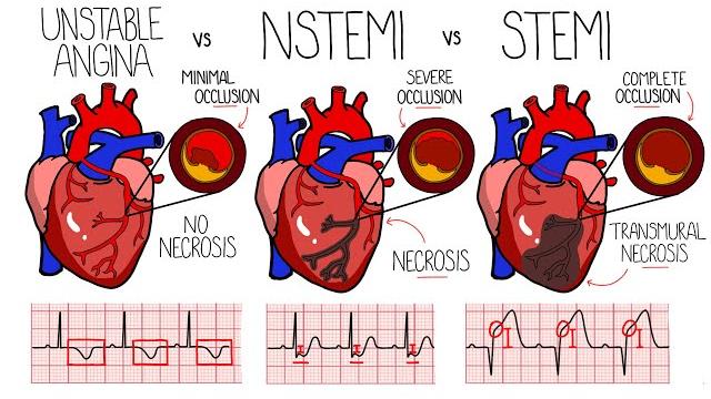 Acute coronary syndrome (heart attack) - unstable angina vs nstemi vs stemi | with ecgs Acute coronary syndrome (heart attack) - unstable angina vs nstemi vs stemi | with ecgs