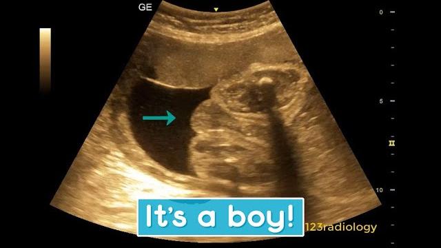 Ultrasound showing boy baby !!! Ultrasound showing boy baby !!!