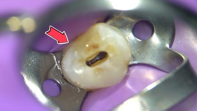 Live: root canal procedure under the microscope w/ specialist Live: root canal procedure under the microscope w/ specialist