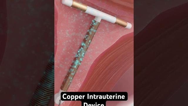 Copper iud birth control (3d animation) Copper iud birth control (3d animation)