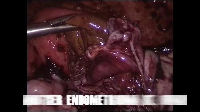 Laparosopic ovarian cystectomy Laparosopic ovarian cystectomy