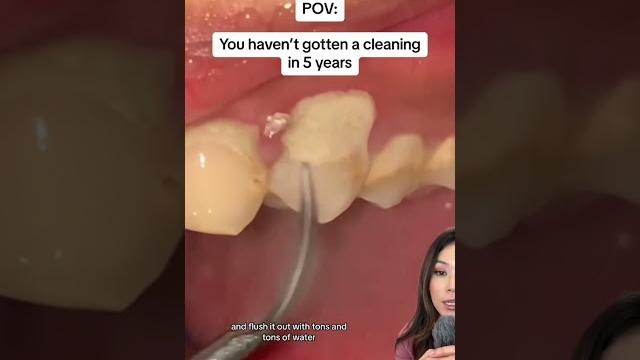 Getting a teeth cleaning after 5 years. #teethcleaning #tartarremoval #plaque #tartar Getting a teeth cleaning after 5 years. #teethcleaning #tartarremoval #plaque #tartar