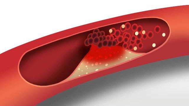 Cholesterol animation | heart disease risk factors Cholesterol animation | heart disease risk factors