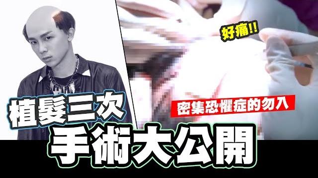 植髮三次的心路歷程大公開,高額頭請進!!|有密集恐懼症的勿入|【酷炫老師-幹話教室#38】 植髮三次的心路歷程大公開,高額頭請進!!|有密集恐懼症的勿入|【酷炫老師-幹話教室#38】