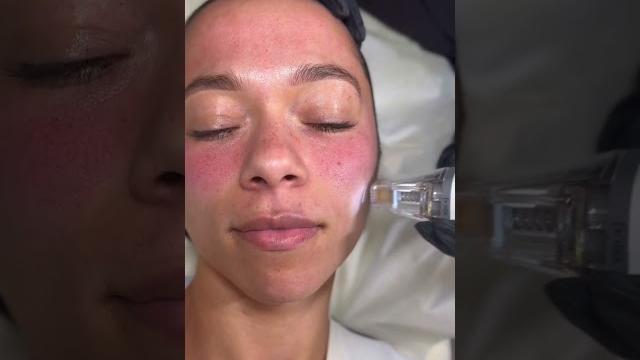 Potenza rf microneedling at sev laser Potenza rf microneedling at sev laser