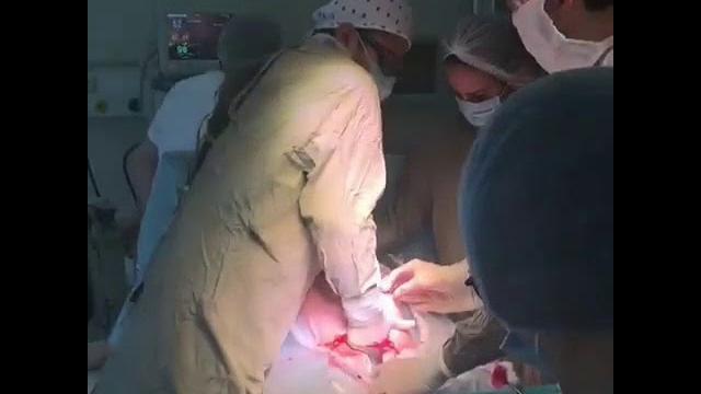 Кесарево сечение двойни Кесарево сечение двойни
