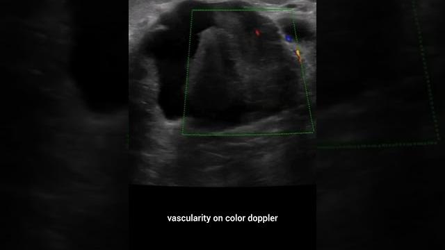 #sonobuzzshorts #breastimaging #sonobuzzshorts #breastimaging