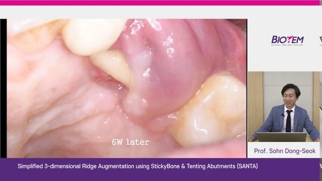 Minimally invasive ridge augmentation Minimally invasive ridge augmentation