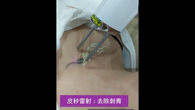 【#刺青立可白:皮秒雷射】皮膚專科楊兆傑醫師 【#刺青立可白:皮秒雷射】皮膚專科楊兆傑醫師