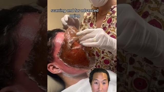 Watch her skin get lifted off her face! #phenol #chemicalpeel Watch her skin get lifted off her face! #phenol #chemicalpeel