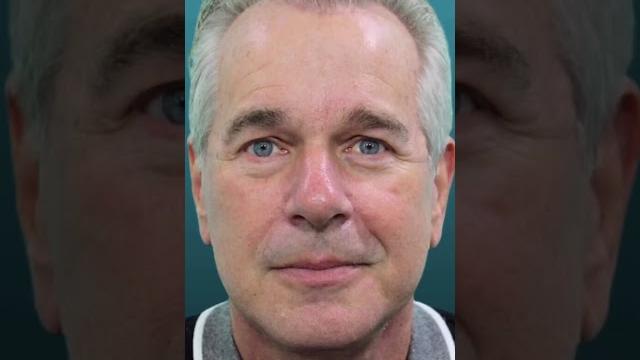 Check this #amazing #beforeandafter of dr.quiroz️ #patients #certified #doctor #facelift Check this #amazing #beforeandafter of dr.quiroz️ #patients #certified #doctor #facelift