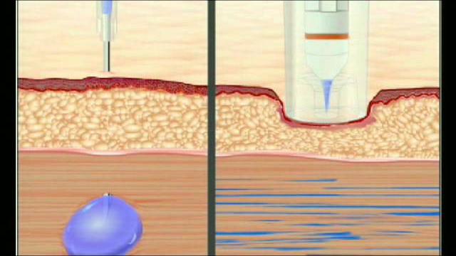 Needle vs needle free injection Needle vs needle free injection