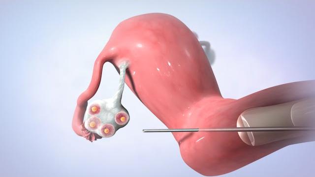 In vitro fertilization (ivf) In vitro fertilization (ivf)