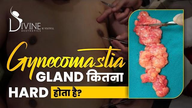 Gynecomastia gland कितना hard होता है? #viralvideo Gynecomastia gland कितना hard होता है? #viralvideo