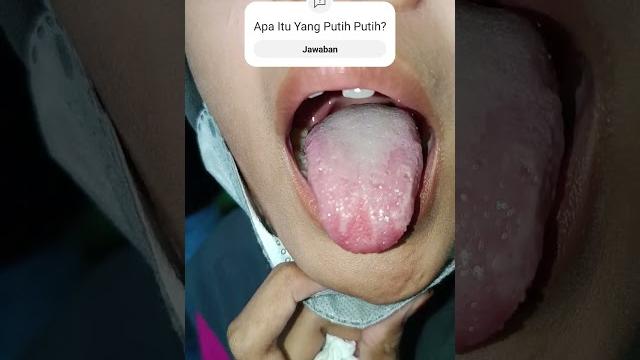 Batu tonsil, batu amandel, atau tonsillolith #dokter #amandel #kesehatan #anak #fyp #shorts #shoerts Batu tonsil, batu amandel, atau tonsillolith #dokter #amandel #kesehatan #anak #fyp #shorts #shoerts