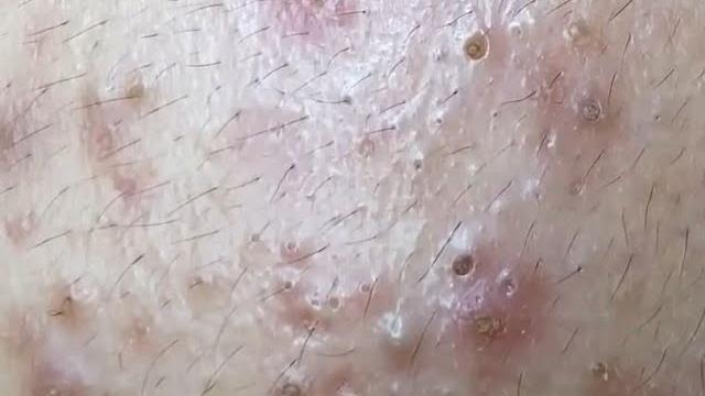 #5 blackhead removal \ удаление черных точек #5 blackhead removal \ удаление черных точек