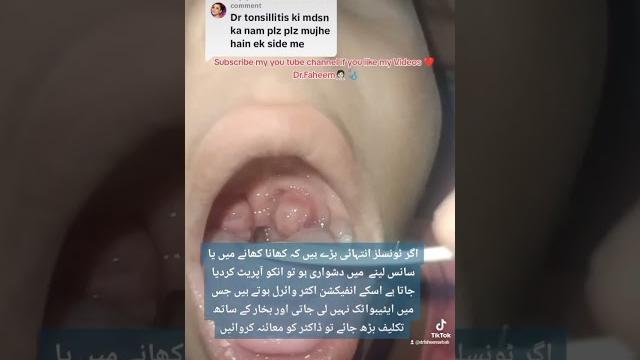 Large tonsils | tonsillitis|tonsillectomy | baray galon ka ilaj | bhokh ka na lagna|galay me takleef Large tonsils | tonsillitis|tonsillectomy | baray galon ka ilaj | bhokh ka na lagna|galay me takleef
