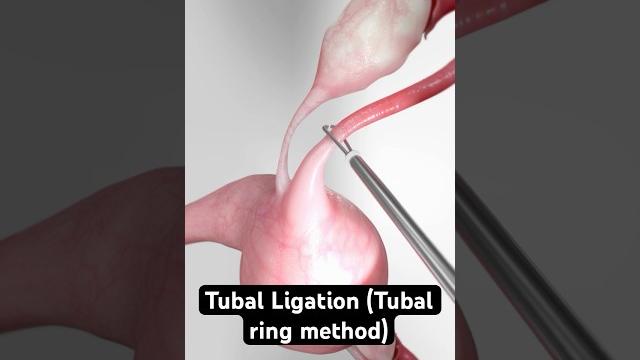 Elastic birth control (3d animation) Elastic birth control (3d animation)