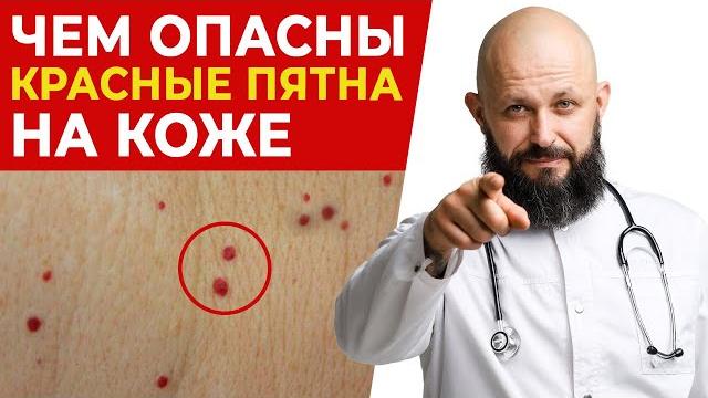 Появляются красные родинки — что это такое и как их убрать? Появляются красные родинки — что это такое и как их убрать?