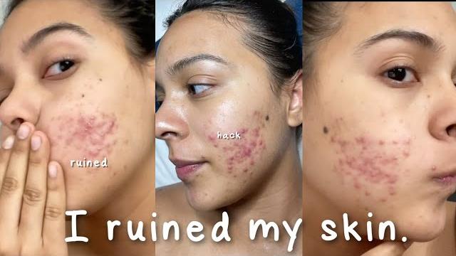 I ruined my skin with this beauty hack... #shorts #skincare I ruined my skin with this beauty hack... #shorts #skincare