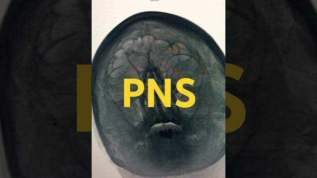 Xray pns sinusitis #anatomy #xraytechnician #humananatomy #radiologycareer #doctor #xray #humanbody Xray pns sinusitis #anatomy #xraytechnician #humananatomy #radiologycareer #doctor #xray #humanbody