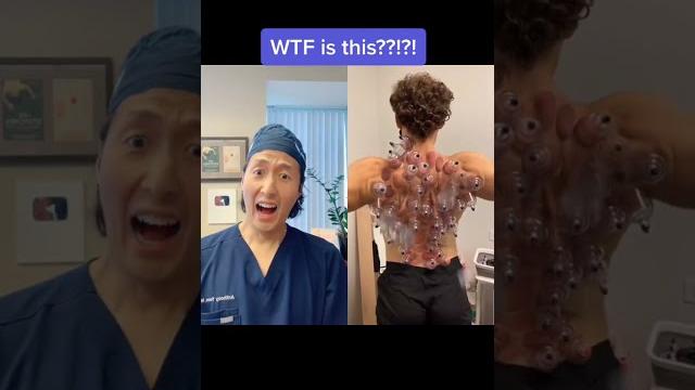 Extreme cupping therapy! #shorts #cupping Extreme cupping therapy! #shorts #cupping