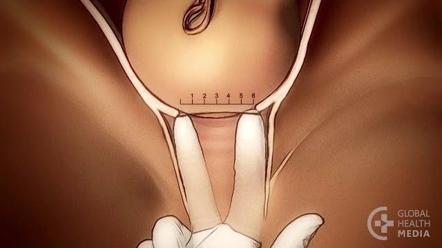 The vaginal exam in labor - childbirth series The vaginal exam in labor - childbirth series