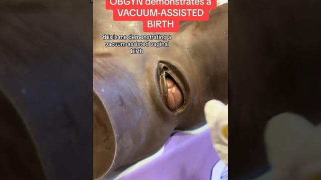 #obgyn shows vacuum-assisted #birth. #shorts #obgyn shows vacuum-assisted #birth. #shorts