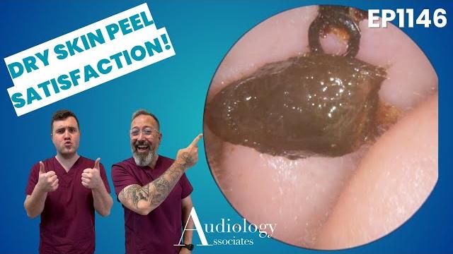 Mega ear wax removal! deep microsuction with skin peel | pediatric & adult cases ep1146 Mega ear wax removal! deep microsuction with skin peel | pediatric & adult cases ep1146