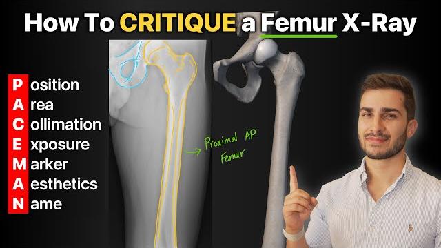 How to critique a femur x-ray! How to critique a femur x-ray!