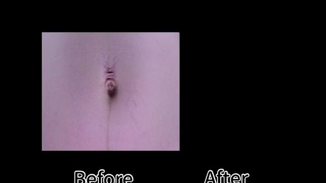 妊娠紋是可以改善的!黃金治療時間一定要把握!#shorts 妊娠紋是可以改善的!黃金治療時間一定要把握!#shorts