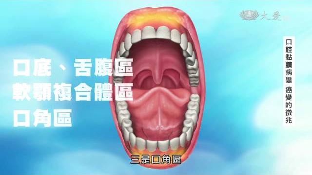 【口腔癌】口腔黏膜病變 癌變的徵兆 【口腔癌】口腔黏膜病變 癌變的徵兆