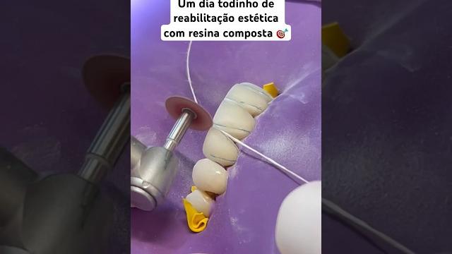 Estética dental com resina composta #dentistica #dentista #odonto #facetadental #facetas Estética dental com resina composta #dentistica #dentista #odonto #facetadental #facetas