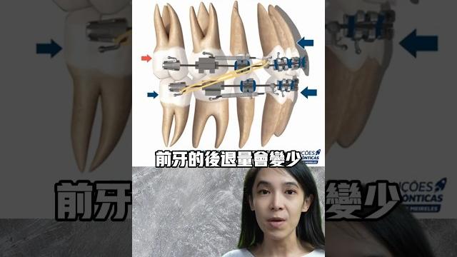 牙套骨釘作用,爲什麼通常只打在上顎#牙齒矯正#骨釘 牙套骨釘作用,爲什麼通常只打在上顎#牙齒矯正#骨釘