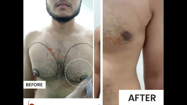 Before after of grade 2b gynecomastia Before after of grade 2b gynecomastia