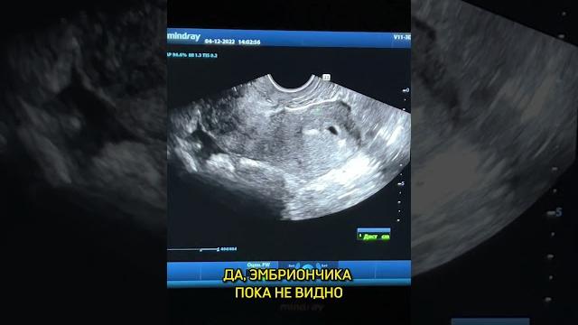 Трансвагинальное узи на лучшем аппарате с топ гинекологом и узи-специалистом-наидой рамазановной Трансвагинальное узи на лучшем аппарате с топ гинекологом и узи-специалистом-наидой рамазановной