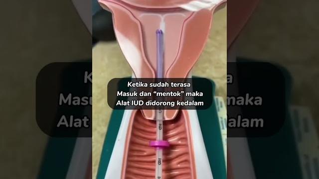 Cara memasukan kb iud kedalam rahim!! | kb spiral dalam rahim! #kb #kbiud #tipskbiud #kbspiral Cara memasukan kb iud kedalam rahim!! | kb spiral dalam rahim! #kb #kbiud #tipskbiud #kbspiral