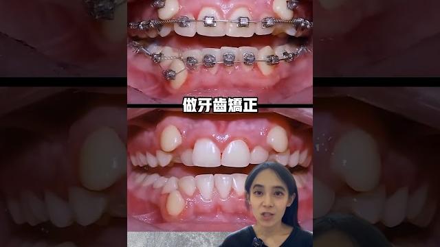高位虎牙的矯正#牙齒矯正#修牙縫#拔牙矯正 高位虎牙的矯正#牙齒矯正#修牙縫#拔牙矯正